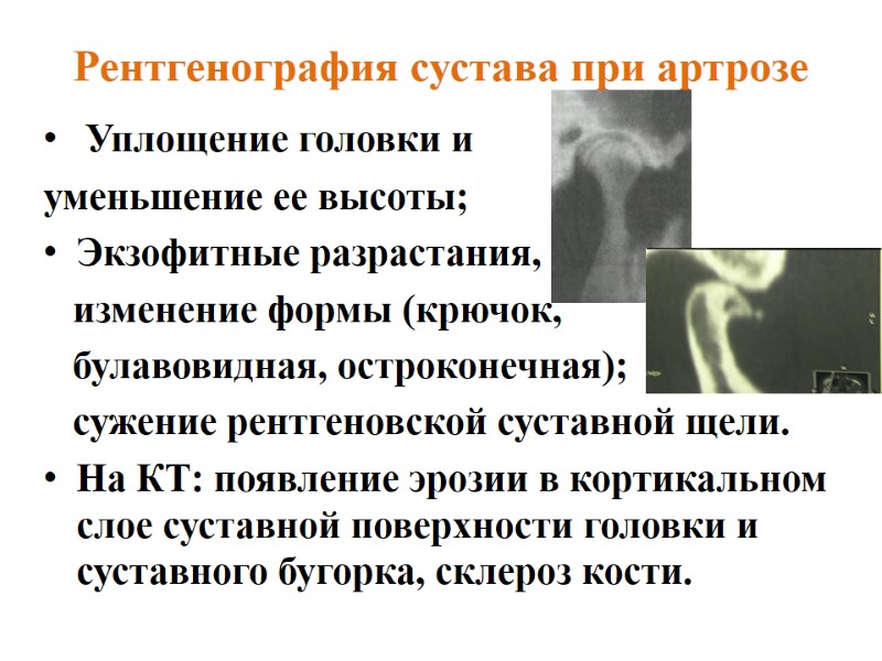 Рентгенография сустава при артрозе  Уплощение головки и  уменьшение ее высоты;  Экзофитные